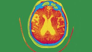 Experimental therapy gantenerumab fails to slow or improve Alzheimer's memory loss in clinical trials